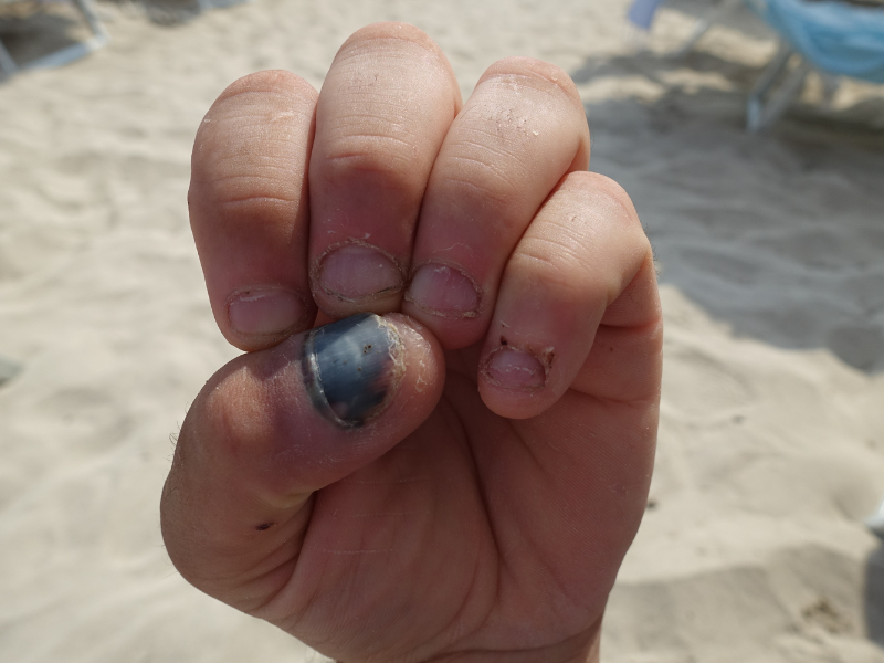 How Long Does It Take for Nails to Grow Back Completely? Fingernails vs. Toenails