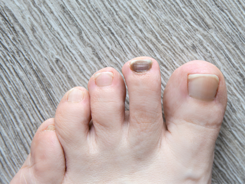 How Do Tight Shoes Affect Toenails? Changes in Nail Growth and Shape