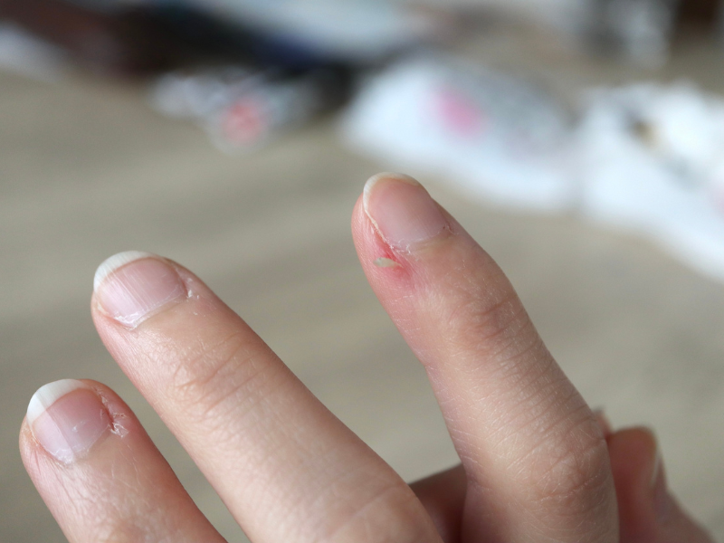 Why Do Hangnails Happen? Common Causes and How to Prevent Them
