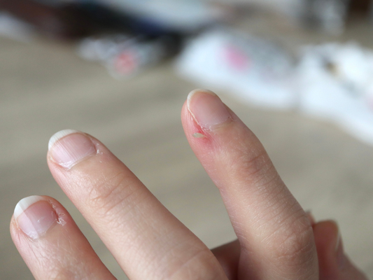 Why Do Hangnails Happen? Common Causes and How to Prevent Them