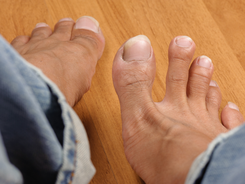 What Causes Thick Toenails? How to Care for Thick Toenails Properly