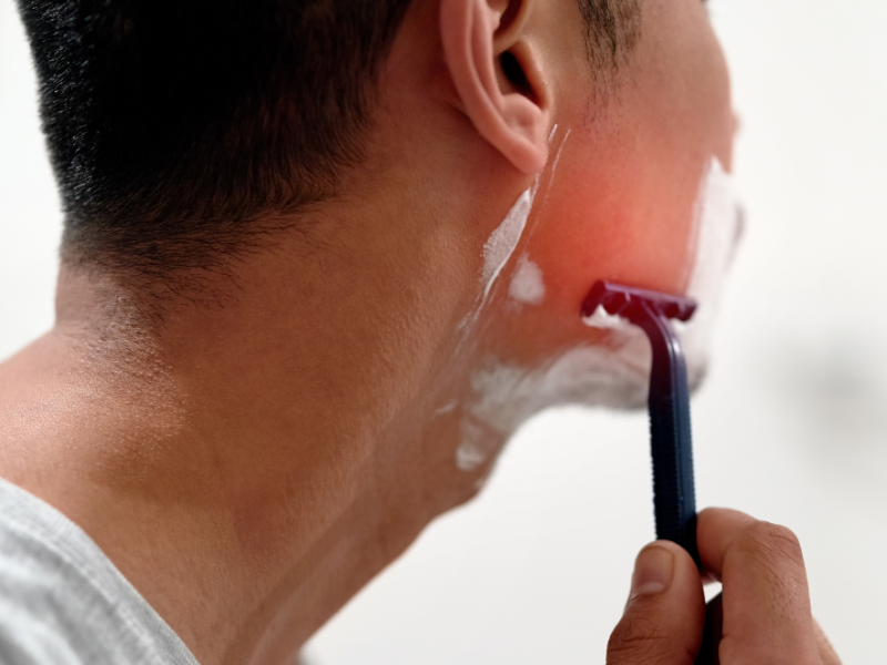 Shaving Acne, Ingrown Hairs, and Razor Bumps: Causes and Prevention