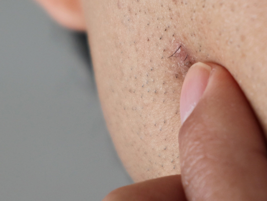 Why Do You Get Ingrown Hairs from Shaving? How Can You Prevent Them?