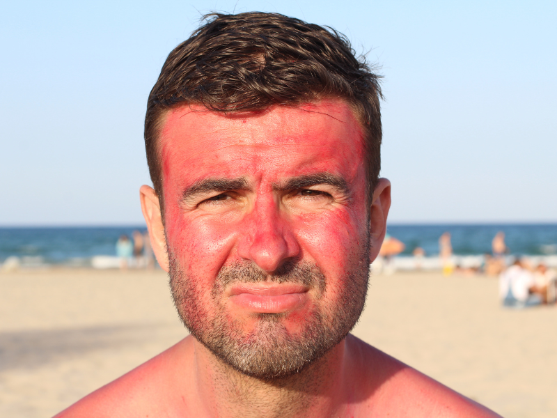 Electric Shaver or Razor After Sunburn: Which Is Better for Your Skin?