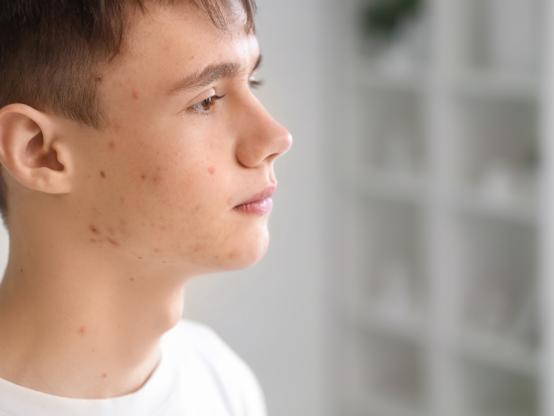 What Should You Do Before Shaving? A Simple Pre-Shave Routine to Prevent Acne and Irritation