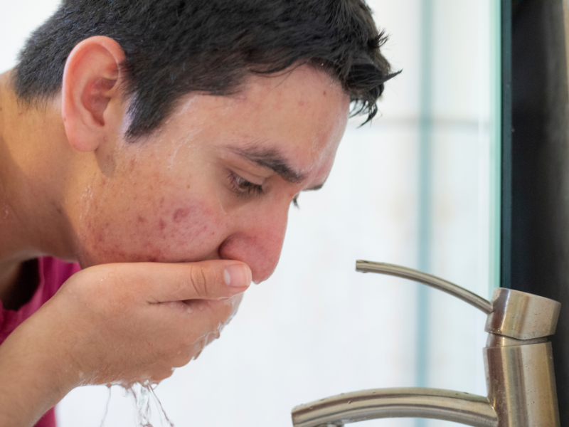 Acne After Shaving? 6 Post-Shave Mistakes You Must Avoid