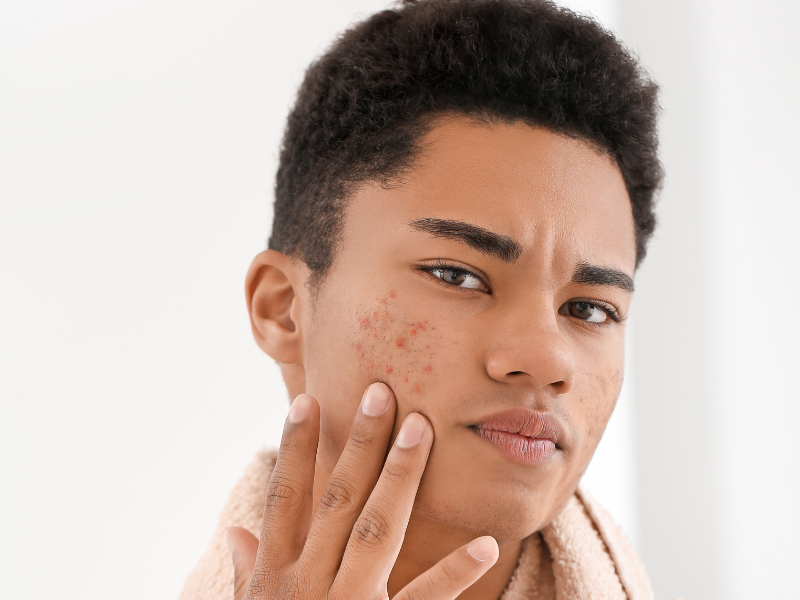 Why Does Shaving Cause More Acne? Causes and the Right Way to Prevent It