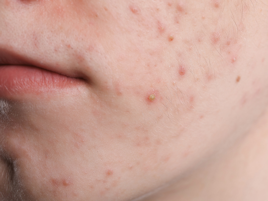 How to Shave Safely with Acne-Prone Skin: Causes of Razor Irritation and How to Prevent It